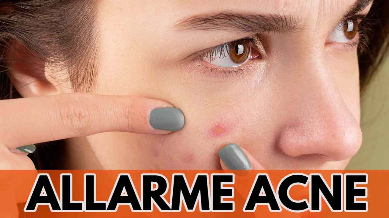 allarme acne direttanews.com 20221018